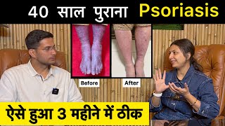 Psoriasis Treatment In Hindi Ft upasanakiduniya  Skin Disease  Himanshu Bhatt [upl. by Zicarelli663]