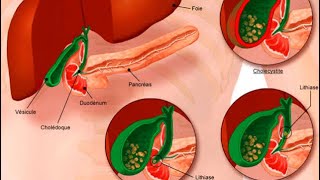 GASTROENTEROLOGIE  angiocholite pancréatite aigue cholécystite aigue colique hépatique [upl. by Bell]