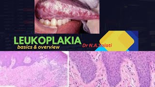 Leukoplakia Differential Diagnosis [upl. by Aileen]