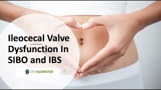 Healing The Ileocecal Valve amp Why Its Important In SIBOIBS [upl. by Valerlan]