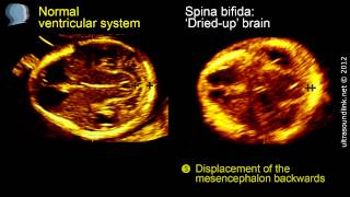 Spina bifida 3D ultrasound diagnosis at 1113 weeks [upl. by Eelarol441]