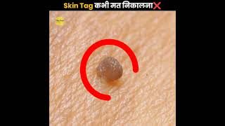 Skin Tag कभी मत निकालना ❌  Never Remove Skin Tag  The Fact  shorts ytshorts [upl. by Rox]