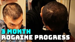 3 Month Rogaine Results and Progress Minoxidil [upl. by Marquardt]