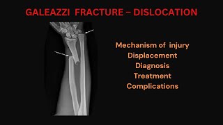 GALEAZZI FRACTURE DISLOCATION INJURY MECHANISM DISPLACEMENT DIAGNOSIS TREATMENT amp COMPLICATIONS [upl. by Aysahc6]