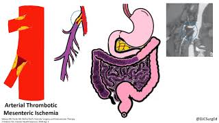 Acute Mesenteric Ischemia [upl. by Pompea]