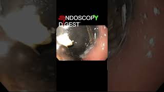 Endoscopy appearance of intragastric migrated lapband shorts [upl. by Branca]