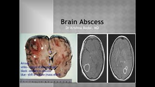 Brain Abscess [upl. by Acissey]