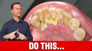 The 1 Top Remedy for Dental Plaque TARTAR [upl. by Oralee]