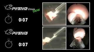 Piranha laser enucleation system from Richard Wolf [upl. by Suoinuj]