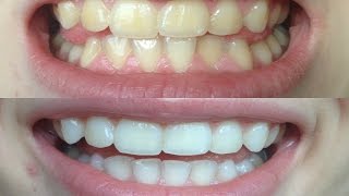 How I whitened my VERY yellow teeth WORKS BEFORE AND AFTER [upl. by Yentrok]