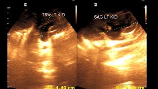 Bilateral hydro nephrosis  Bilateral dilated ureter  Renal Ultrasonography [upl. by Lenhart641]