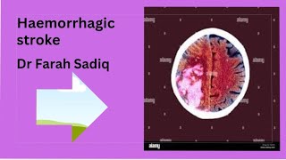 haemorrhagic  stroke  subarachnoid hemorrhage subdural extradural hematoma [upl. by Aivle807]