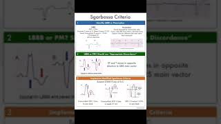 Modified Sgarbosa criteria for diagnosis of STEMI in LBBB or paced rhythm ECG [upl. by Garmaise155]