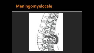 Spina Bifida Occulata Meningocele amp Meningomyelocele [upl. by Hube]