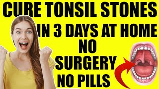 Tonsil Stones Treatment Removal At Home  Get Rid Of Tonsil Stones In JUST 3 Days FOREVER [upl. by Anirahc]