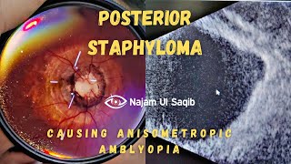 Posterior Staphyloma Causing Myopic Anisometropic Amblyopia [upl. by Nnylyam]