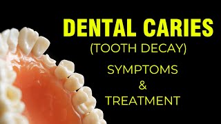 Dental Caries Tooth Decay  Symptoms  Treatment [upl. by Hadnama105]