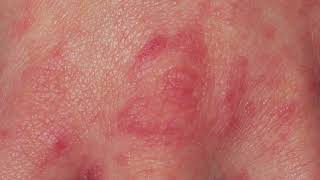 DO YOU HAVE SCABIES CLOSE LOOK AT THE SCABIES RASH [upl. by Hibbitts]