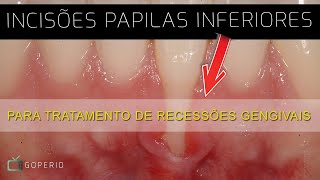 Ep 79 Incisão papila inferior [upl. by Darrel848]