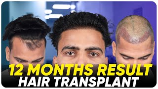 Hair Transplant in Abu Dhabi  Best Results amp Cost of Hair Transplant in Abu Dhabi [upl. by Refitsirhc592]