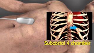 Echocardiographic view  Subcostal view  4 chamber [upl. by Shannah]