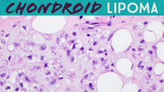 Chondroid lipoma has lipoblasts but not liposarcoma Basic soft tissue pathology [upl. by Brett]