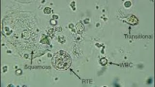 Urine Sediment Epithelial Cells [upl. by Atsira]