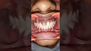 Dental Restoration infected teeth shorts  happy dentalcare dentist dentalhealth viralvideo [upl. by Waiter]