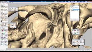 Geomagic Freeform  Reconstruccion de Protesis Mandibula [upl. by Marjana]