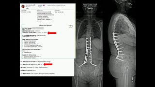 Enhanced Recovery Pathway Evolution – is Adult Deformity Surgery in the ASC Imminent Han Jo Kim MD [upl. by Basham]