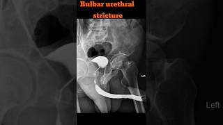 RGU  Retrograde urethrogram  Bulbar urethral stricture shorts rgu radiology specialcase [upl. by Annhej]