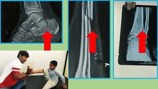 Amazing Chiropractic Adjustment India  Heel Arm Hand Fracture Treatment By Indian Chiropractor [upl. by Yentrac]