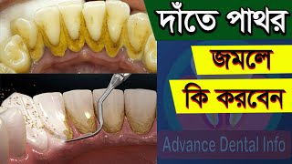 দাঁতের পাথর দূর করার উপায়  Date Pathor Dur Korar Upay  Teeth Stone Removal At Home In Bangla [upl. by Hibbert]