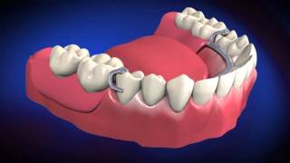 Dentures and Partials [upl. by Vahe]