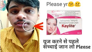 Keylite cream review  Fairness cream side effect  skin whitening cream side effects  side effect [upl. by Capon]