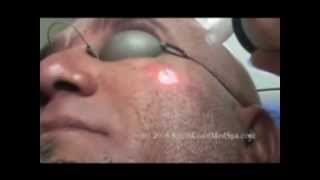 Tratamiento laser para huequitos del acne CLINICA LASER LE PIEL [upl. by Lirpa]