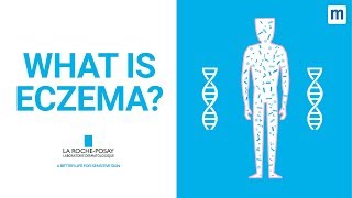 What Is Eczema  La RochePosay [upl. by Dita]