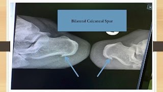 Bilateral Calcaneal Spur [upl. by Juback]