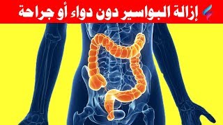 طريقة التخلص سريعا من البواسير وأفضل وسائل إزالة البواسير طبيعيا دون دواء وجراحة [upl. by Jegar]