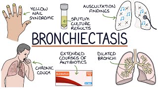 Understanding Bronchiectasis [upl. by Mirelle]