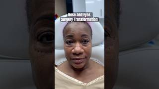 African American Nose Job and Eyelid Surgery 🤩 Beautiful Plastic Surgery Results [upl. by Ardnekan]