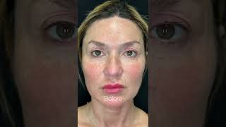 Coolpeel laser skin tightening around the eyes for upper and lower eyelids Before and after results [upl. by Riocard]