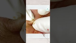 Big Cystic Acne Blackheads Extraction Blackheads amp Milia Whiteheads Removal Pimple Popping shorts [upl. by Pamella]