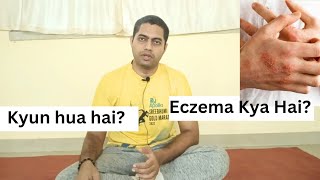 Yoga for Eczema  Eczema kya hai kyun hota hai [upl. by Akenna]