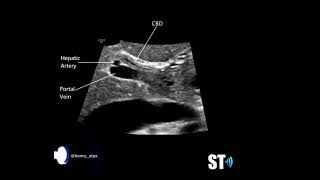 Scanning the Common Bile Duct CBD [upl. by Yelhs]