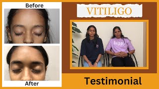 A Mothers Perspective Homeopathic Healing for Vitiligo Success Storyquot  Vitiligo Treatment [upl. by Betta]