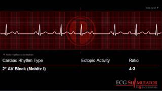 Second Degree AV Block Type I  Wenckebach ECG  EKG ecgsimulatornet [upl. by Cigam]