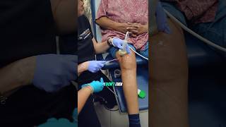 How painful is draining fluid from knee 😬 painmanagment kneepain osteoarthritis [upl. by Olbap991]