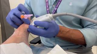 Sesamoid injection for osteoarthritis [upl. by Yuille]