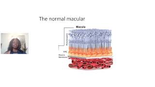 An introduction to the macula and the diseases that affect it with Dr Christiana Dinah [upl. by Armington]